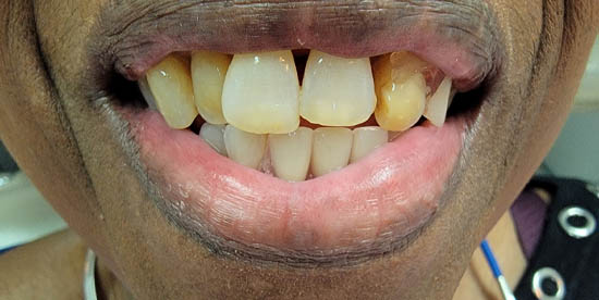 Dentures & Partial Dentures case #3664