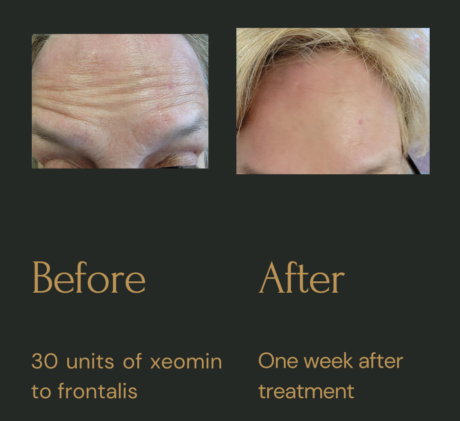 Xeomin/Wrinkle Relaxers case #3681