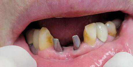 Dental Implants case #4071