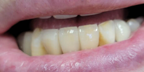 Dental Implants case #4071
