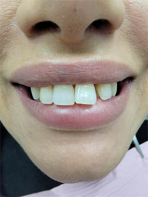 Clear Aligners case #4074