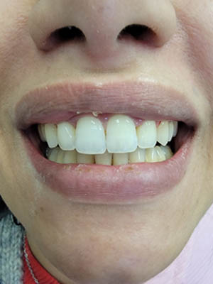 Clear Aligners case #4074