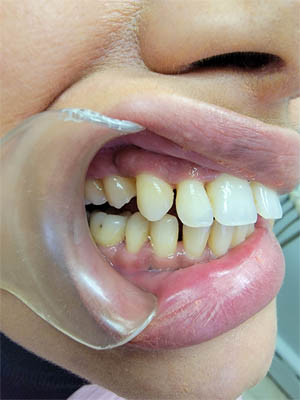 Clear Aligners case #4074