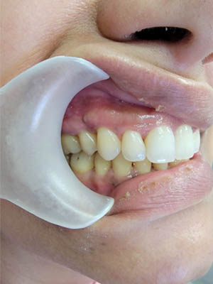 Clear Aligners case #4074