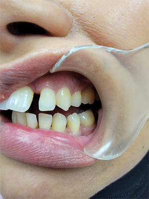 Clear Aligners case #4074