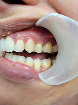 Clear Aligners case #4074