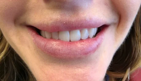 Clear Aligners case #4520