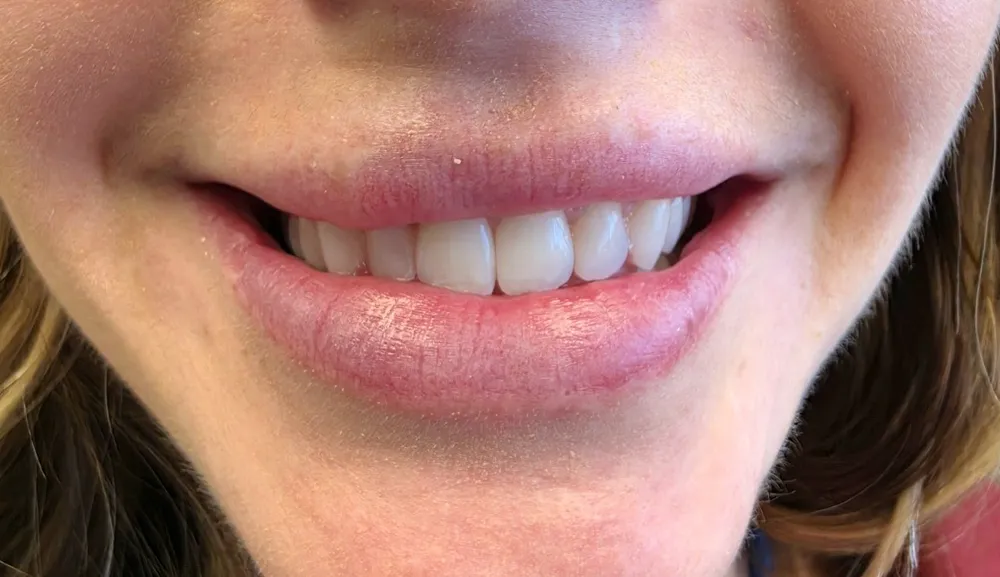 Clear Aligners case #4520