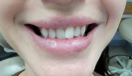 Clear Aligners case #4520