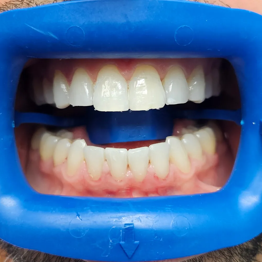 In-Office Whitening case #4532