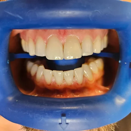 In-Office Whitening case #4532